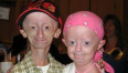 progeria